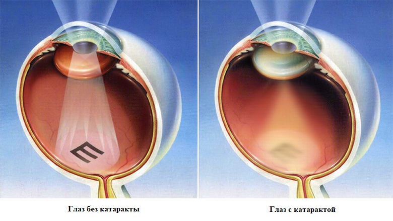 cataract_vision.jpg